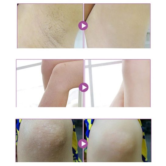 "Aichun Sensitive Parts Whitening Cream - Application on Sensitive Skin."